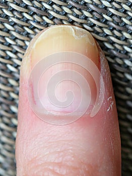 Splitting finger nail