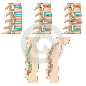 Spondylitis. Inflammatory disease of the spine