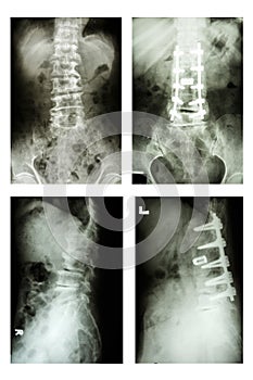 Spondylolisthesis