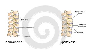 Spondylosis vector illustration