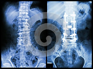 Spondylosis (Left image) , Patient was operated and internal fixed. (Right image)