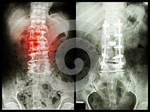 Spondylosis (Left image) , Patient was operated and internal fixed. (Right image) photo