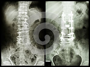 Spondylosis (Left image) , Patient was operated and internal fixed. (Right image) photo