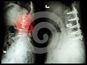 Spondylosis (Left image) , Patient was operated and internal fixed. (Right image) in old man