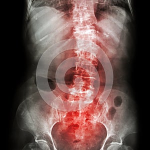 Spondylosis and Scoliosis ( film x-ray lumbar - sacrum spine show crooked spine ) ( old patient ) ( Spine Healthcare ) photo