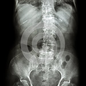 Spondylosis and Scoliosis ( film x-ray lumbar - sacrum spine show crooked spine ) ( old patient ) ( Spine Healthcare )