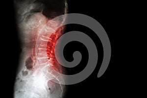 Spondylosis , Spondylolisthesis ( Film x-ray lumbo - sacral spine show spine collapse , decrease in disc space , bony spur format