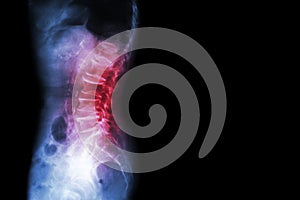 Spondylosis , Spondylolisthesis ( Film x-ray lumbo - sacral spine show spine collapse , decrease in disc space , bony spur format