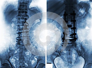 Spondylosis . Before and After surgery .