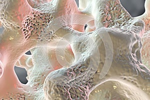 Spongy bone tissue affected by osteoporosis photo