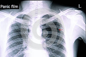 spontaneous pneumothorax