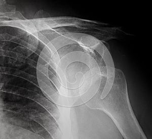 Sport injury- Plain film X-ray, radiography of dislocated shoulder