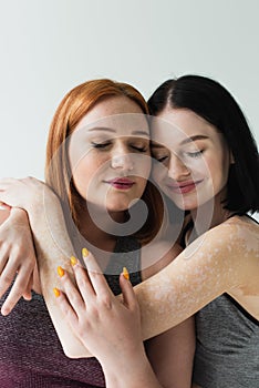 Sportswoman with vitiligo hugging plus size