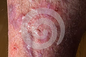 Spots of lichen planus on a male leg. Dermatological immune diseases photo