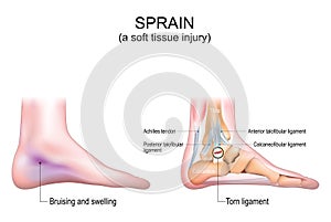 Sprain. A soft tissue injury in the human foot