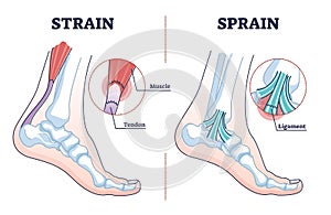 Sprain vs strain anatomical comparison as medical foot injury outline diagram