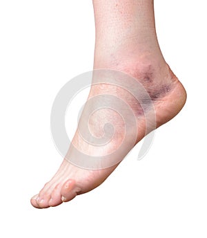 Sprained ankle isolated on white