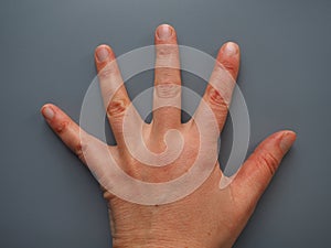 Spread 5 fingers. Female hand with dry atopic skin. White background. Close-up of the skin on the palm and fingers