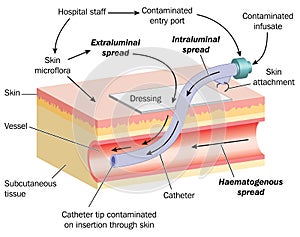 Spread of infection via a cannula photo