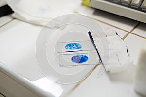 Sputum sample diag Mycrobacterium tuberculosis