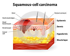 Squamous cell carcinoma