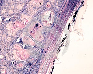 Squamous cell carcinoma of the eyeball photo