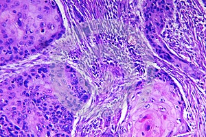 Squamous cell carcinoma of a human photo