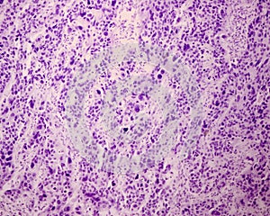 Squamous cell carcinoma