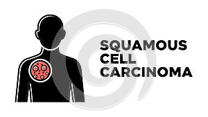 Squamous Cell Carcinoma (SCC)
