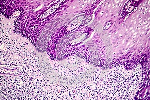Squamous cell carcinoma