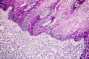 Squamous cell carcinoma photo