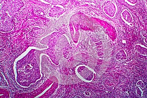 Squamous cell carcinoma of the uterus, light micrograph