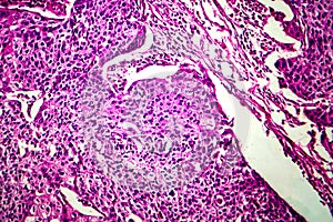 Squamous cell carcinoma of the uterus, light micrograph