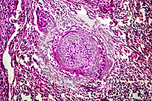 Squamous cell carcinoma of the uterus, light micrograph