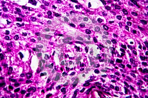 Squamous cell carcinoma of the uterus, light micrograph