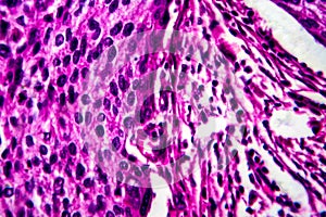 Squamous cell carcinoma of the uterus, light micrograph