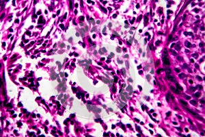 Squamous cell carcinoma of the uterus, light micrograph