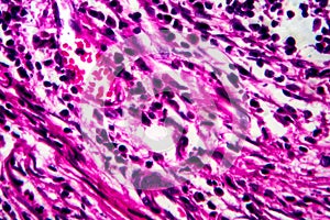 Squamous cell carcinoma of the uterus, light micrograph