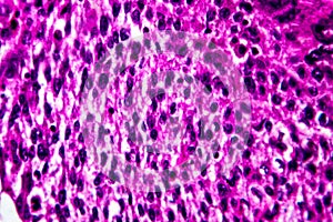 Squamous cell carcinoma of the uterus, light micrograph