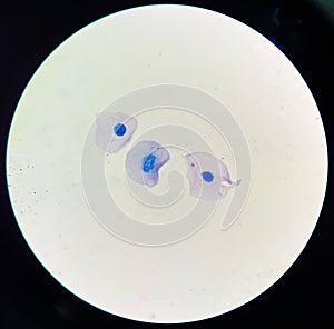Squamous epithelial cell in sputum AFB