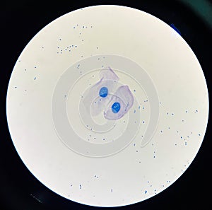 Squamous epithelial cell in sputum AFB