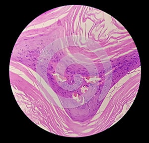 Squamous hyperplasia of Right Lower Bucco Areola