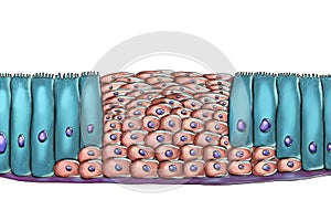 Squamous metaplasia or respiratory epithelium