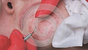 Squeezing acne from a girl with problem skin in the salon using a loop.