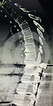 Lumbar spine fusion hardwear  stabilization device photo