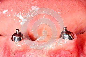 Dental stabilization system