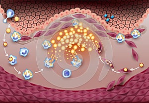 Stable atherosclerotic plaque photo