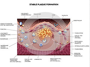 Stable plaque formation, Atherosclerosis