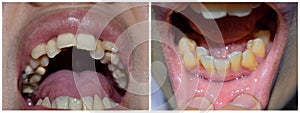 Stacked or overlapping teeth of Asian man. Also called crowded teeth