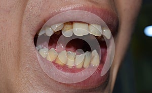 Stacked or overlapping teeth with yellow stain. Also called crowded teeth